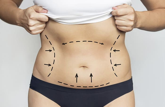 Plicatura abdominal
